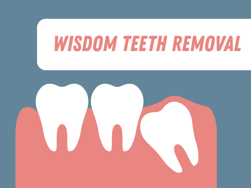 Graphic illustrating the removal of wisdom teeth